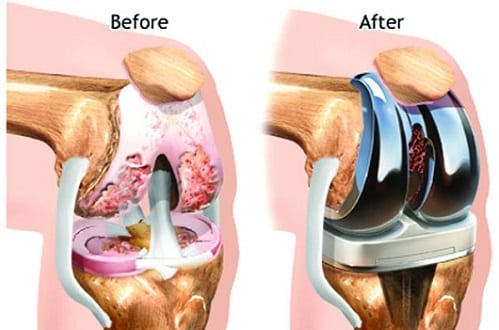 Total-Knee-Replacement